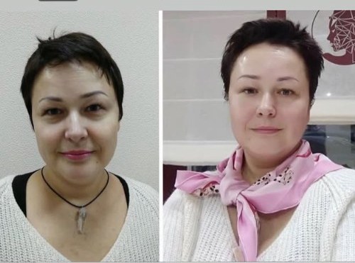 Підтяжка овалу обличчя: до і після курсу процедур